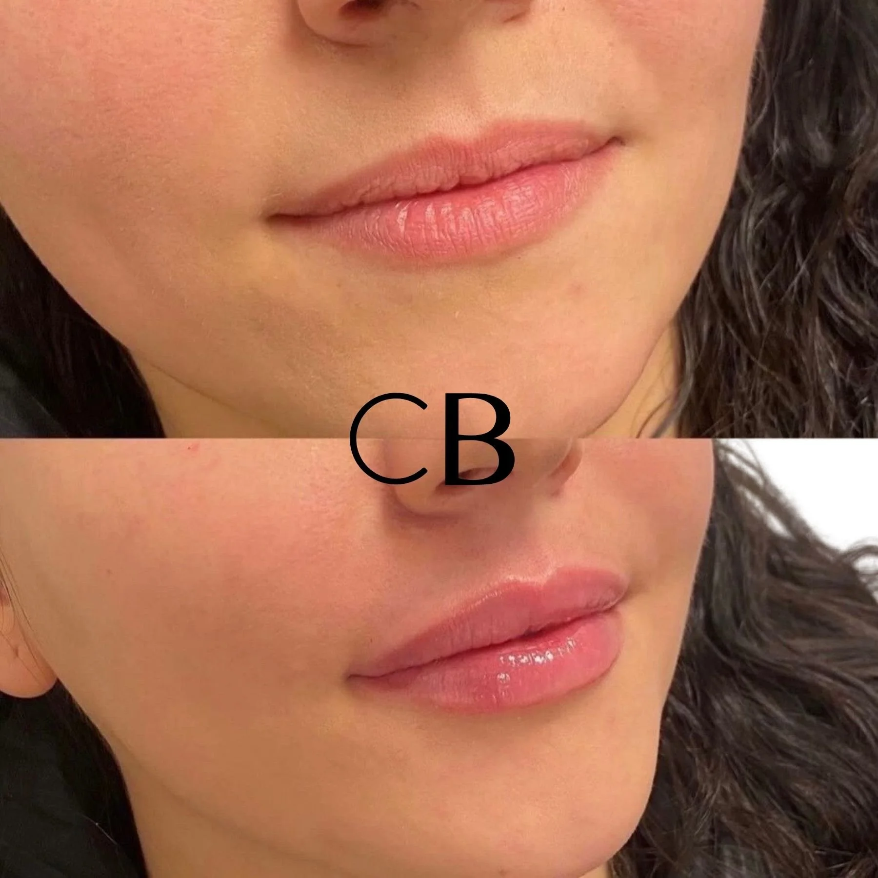 Dermal Filler Before and After