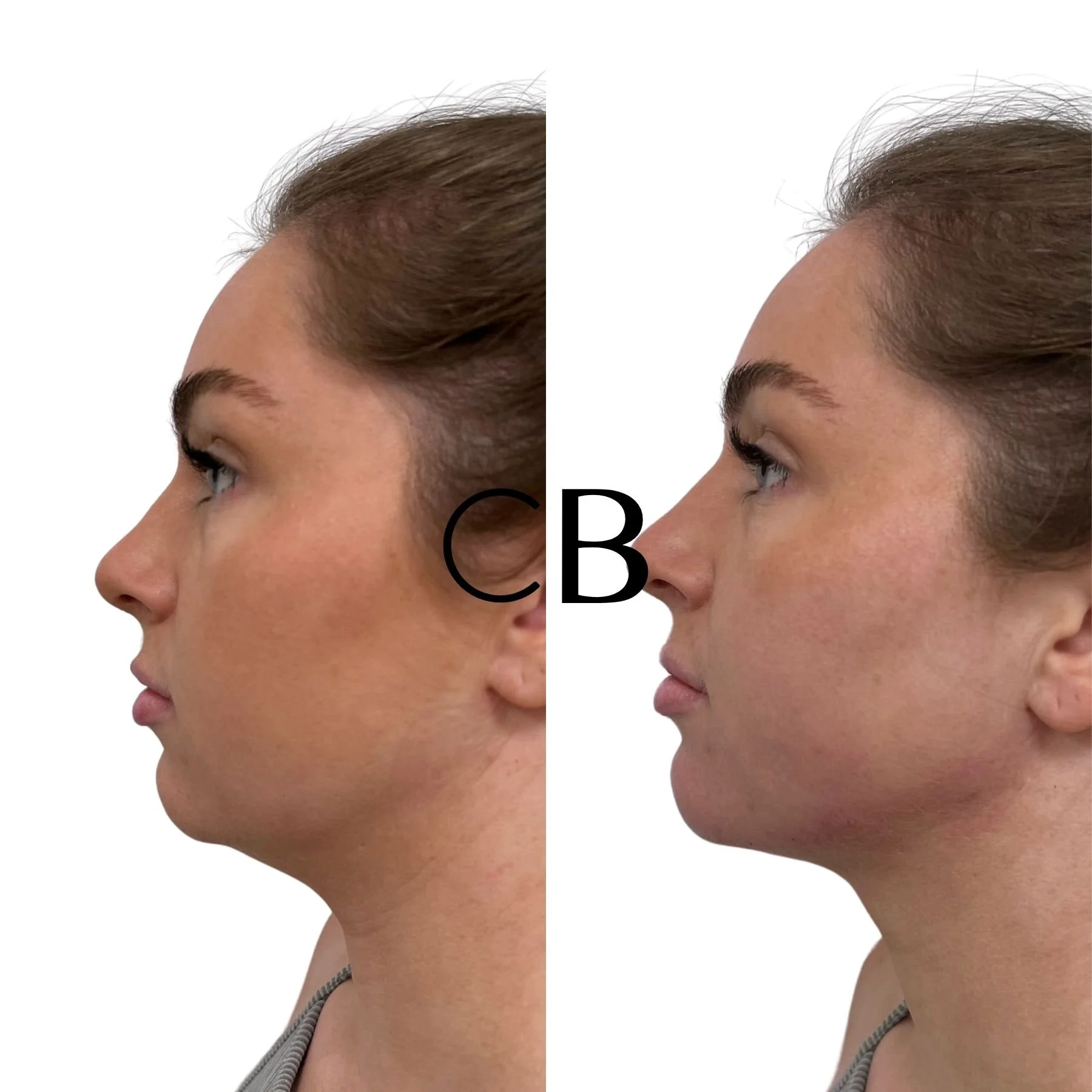 Facial Balancing (Chin & Jawline) by Melissa Berg, BSN RN
