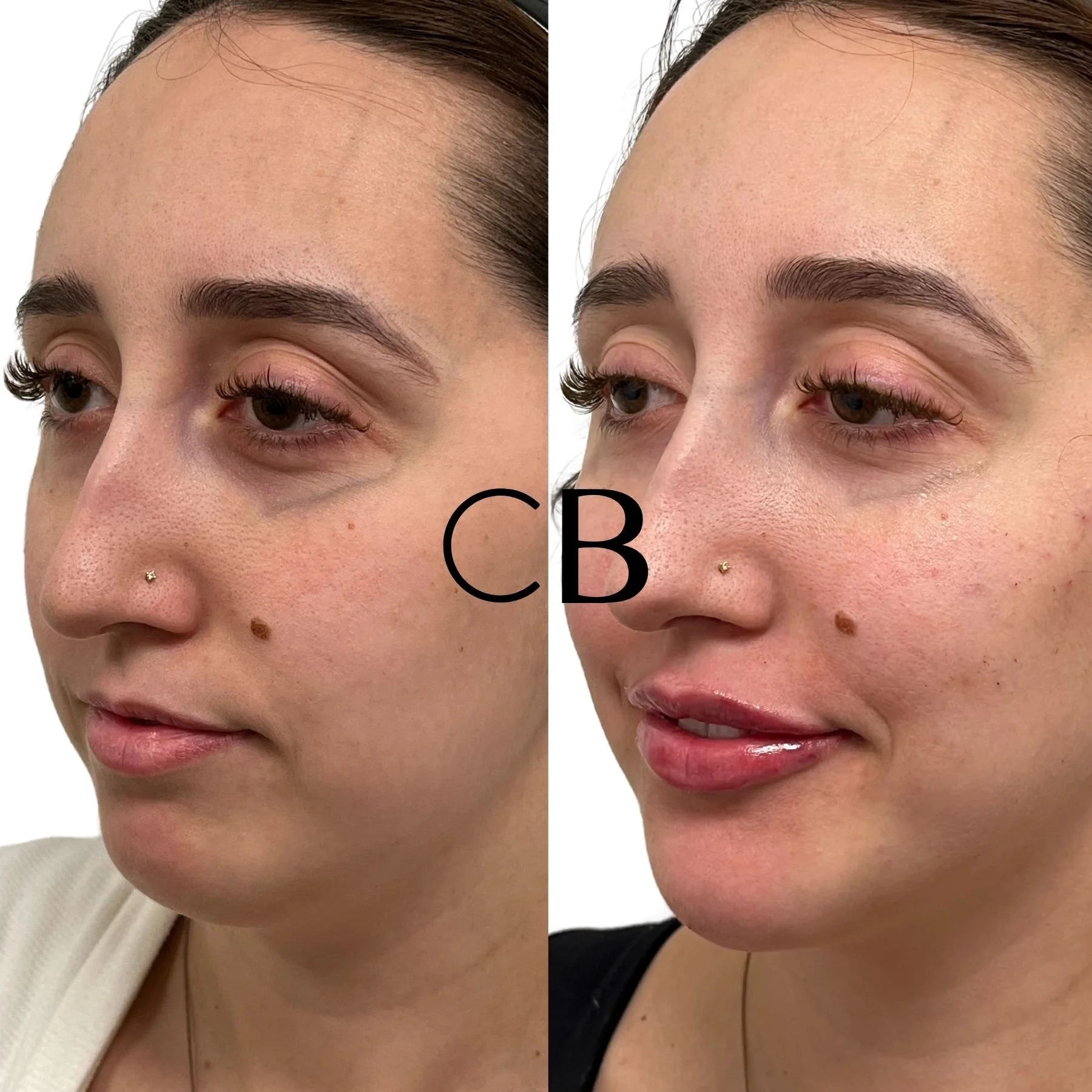 Dermal Filler Before and After