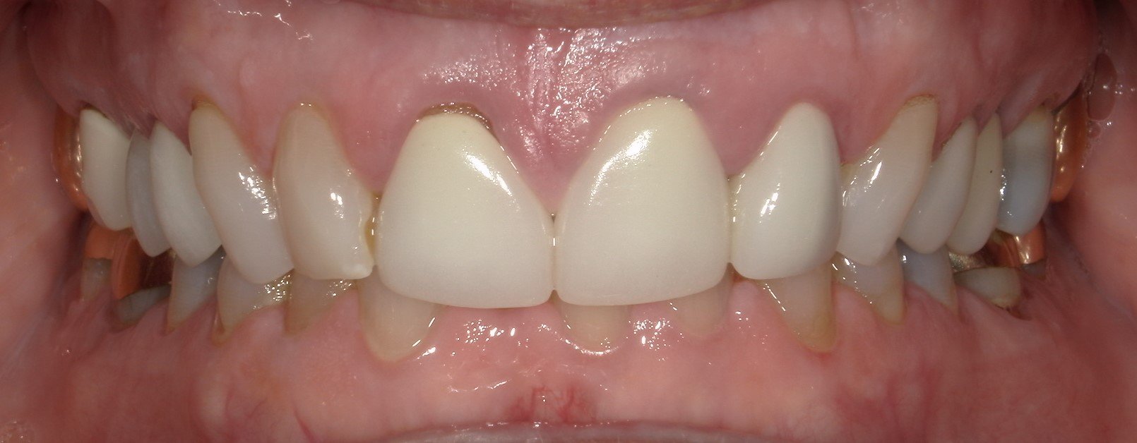 Full Mouth Before Treatment 