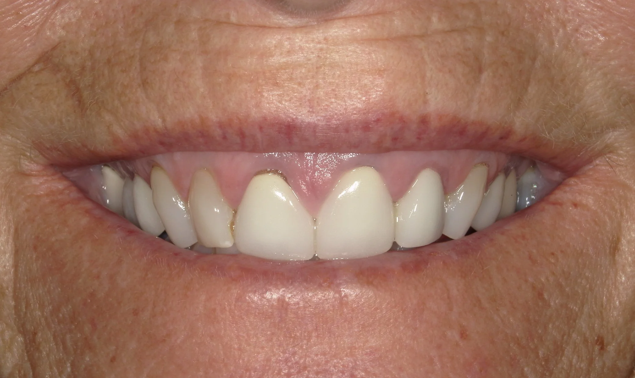 Smile Before Treatment 