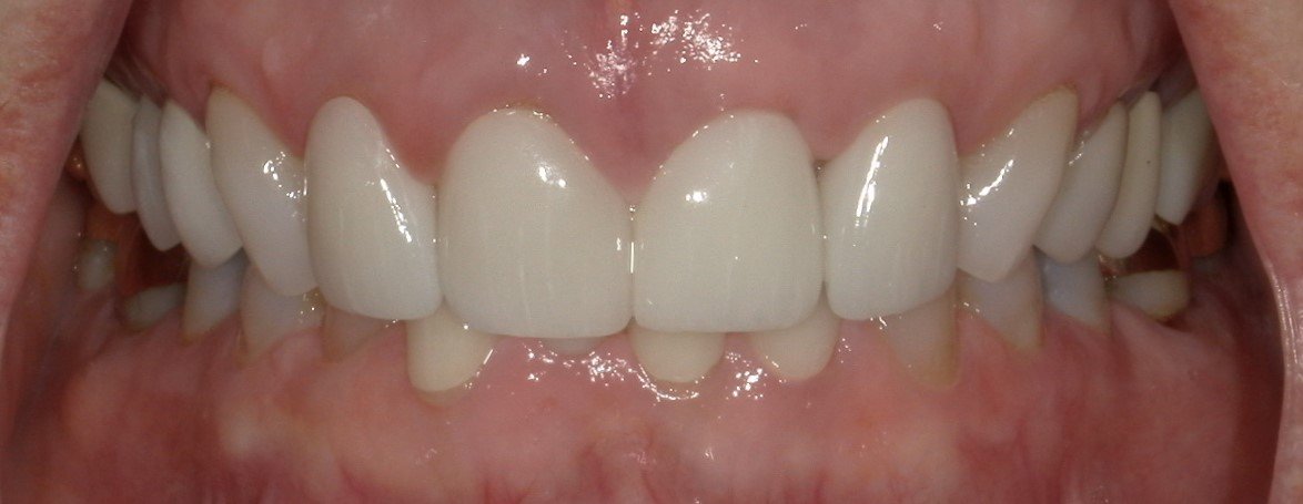 Full Mouth After Treatment