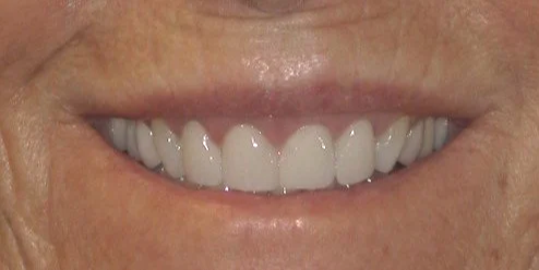 Smile After Treatment