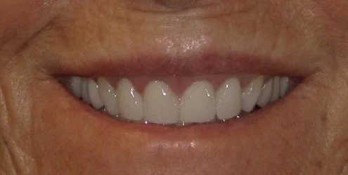 Smile Restoration