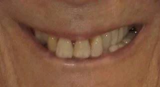 Smile Before Treatment