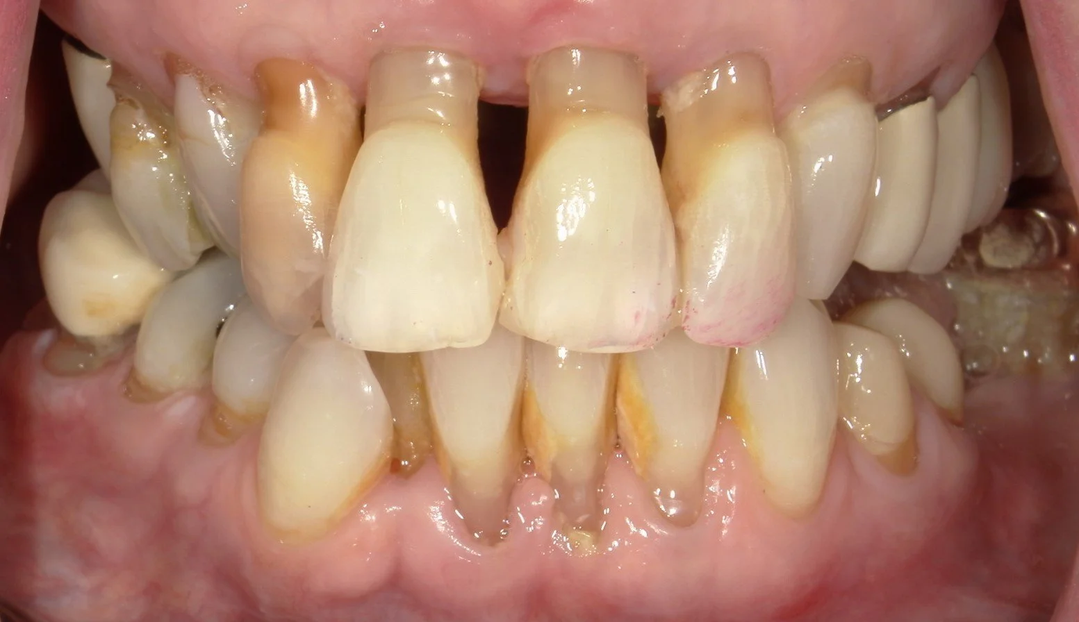 Full Mouth Before Treatment
