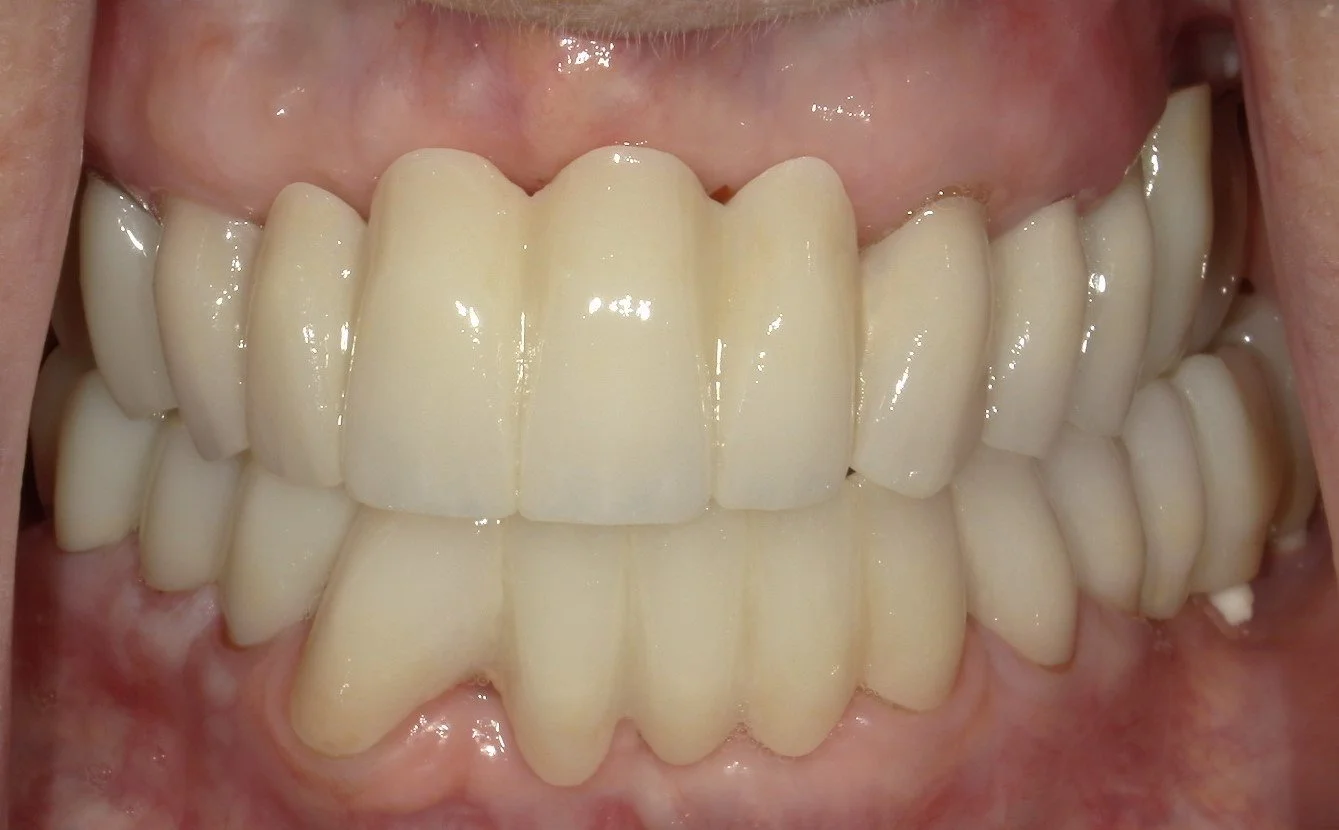 Full Mouth After Treatment