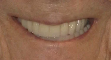 Full Smile Restoration