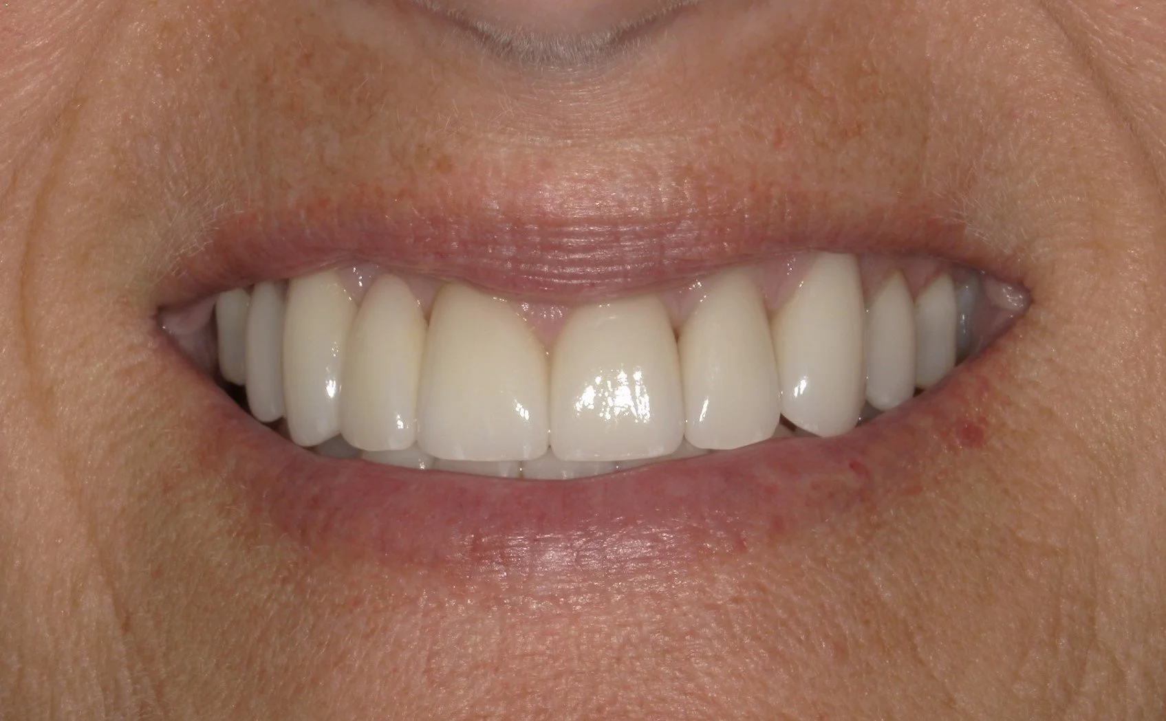 Smile Restoration - 10 year case