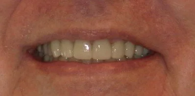 Full Smile Restoration