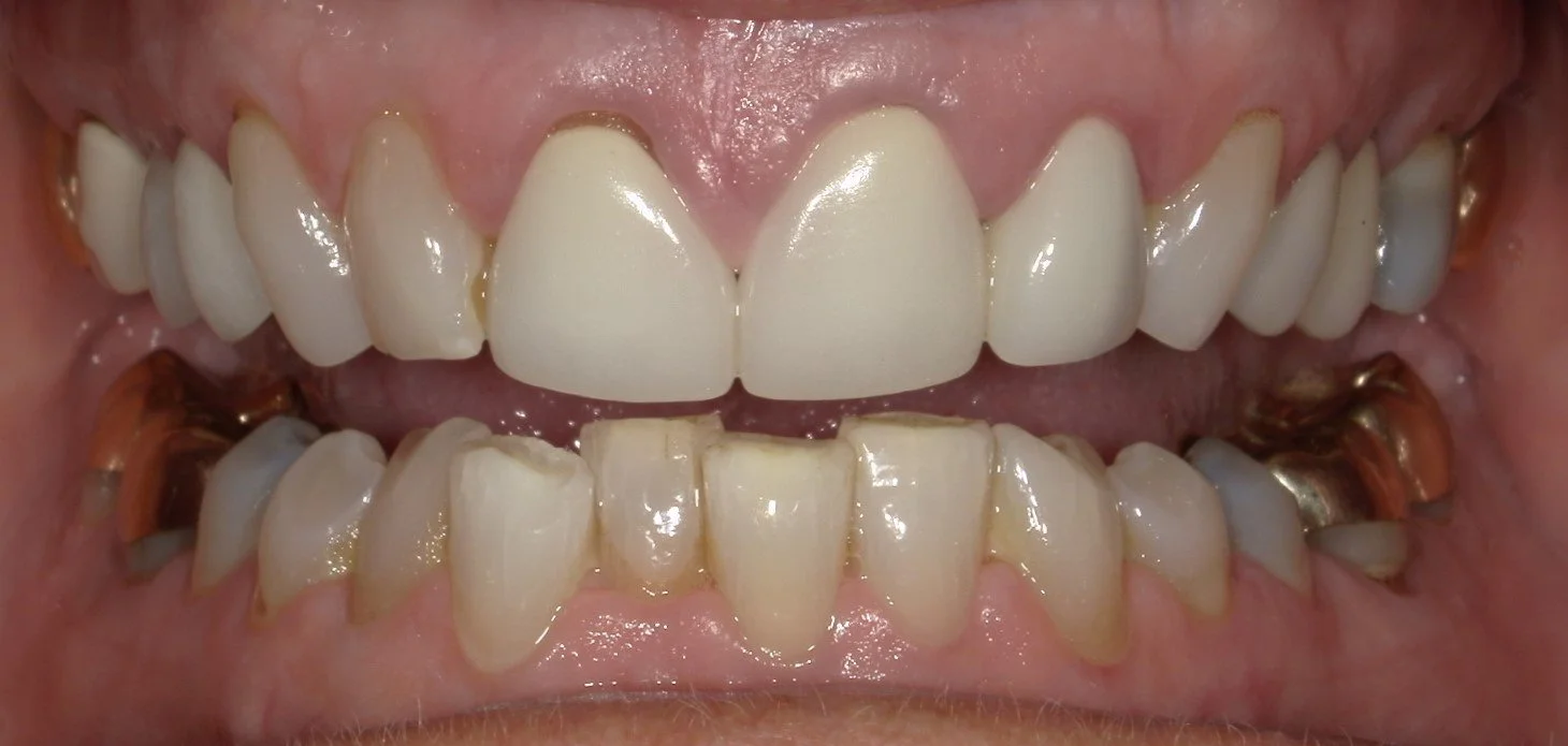 Full Mouth Open Before Treatment 