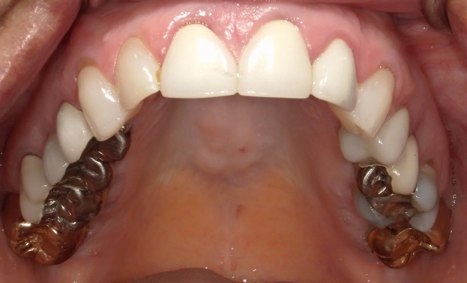 Upper Occlusal Before Treatment 