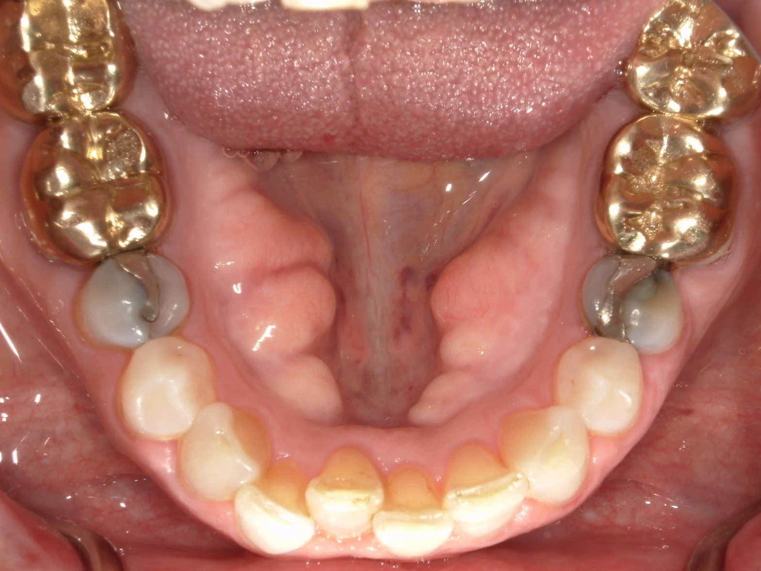 Lower Occlusal Before Treatment