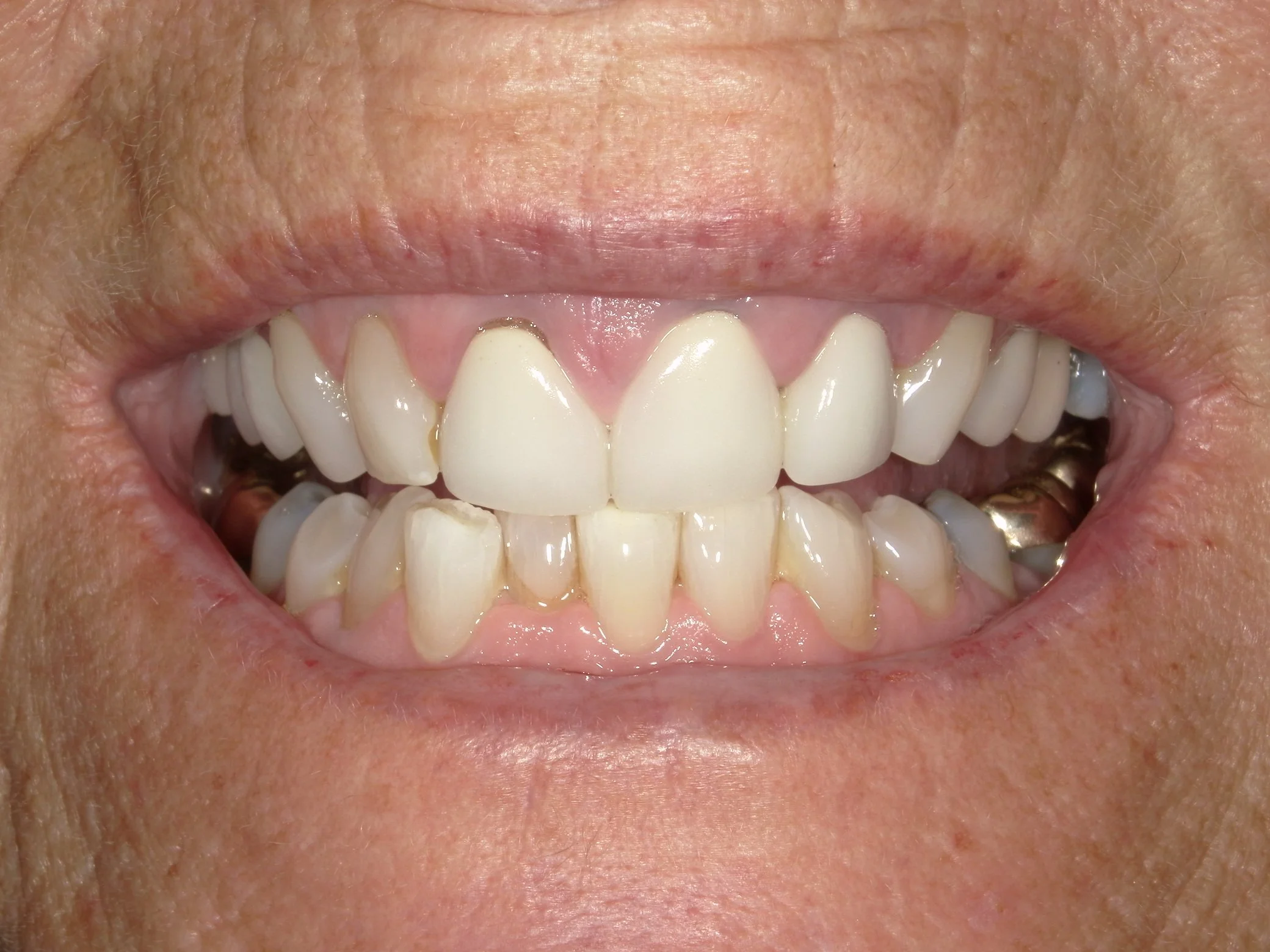 Full Mouth Before Treatment