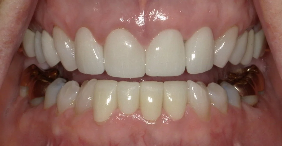 Full Mouth Open After Treatment