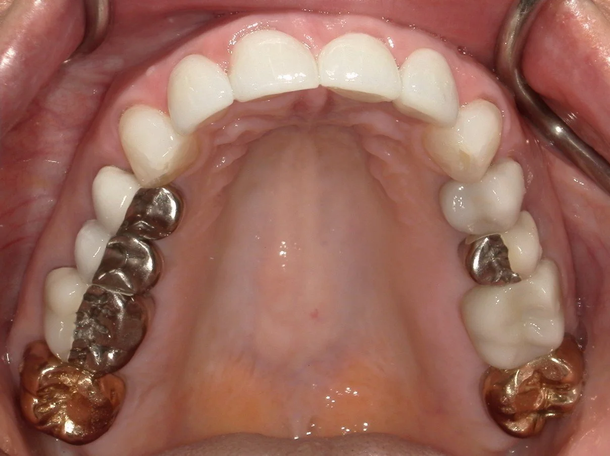 Upper Occlusal After Treatment