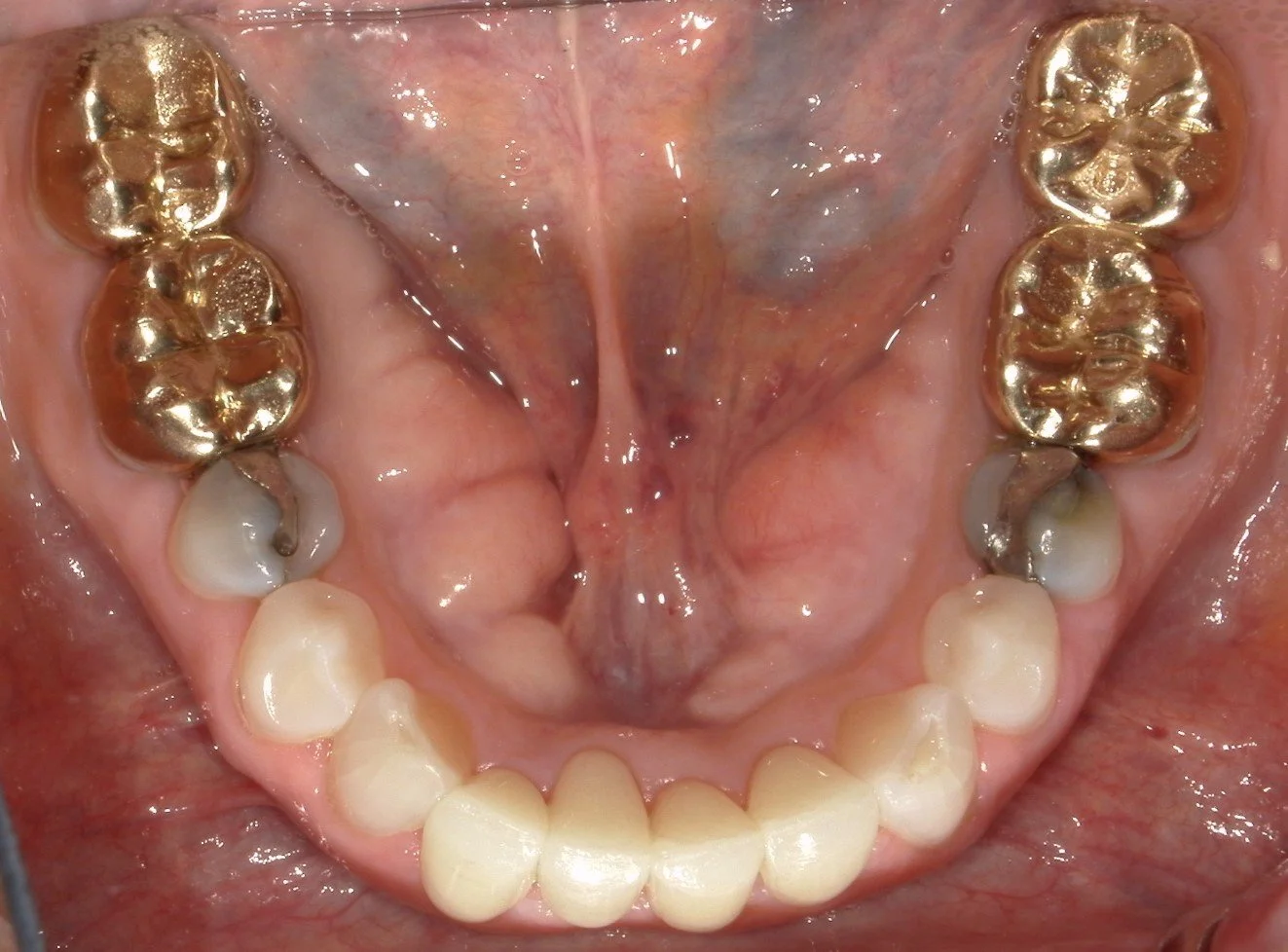 Lower Occlusal After Treatment