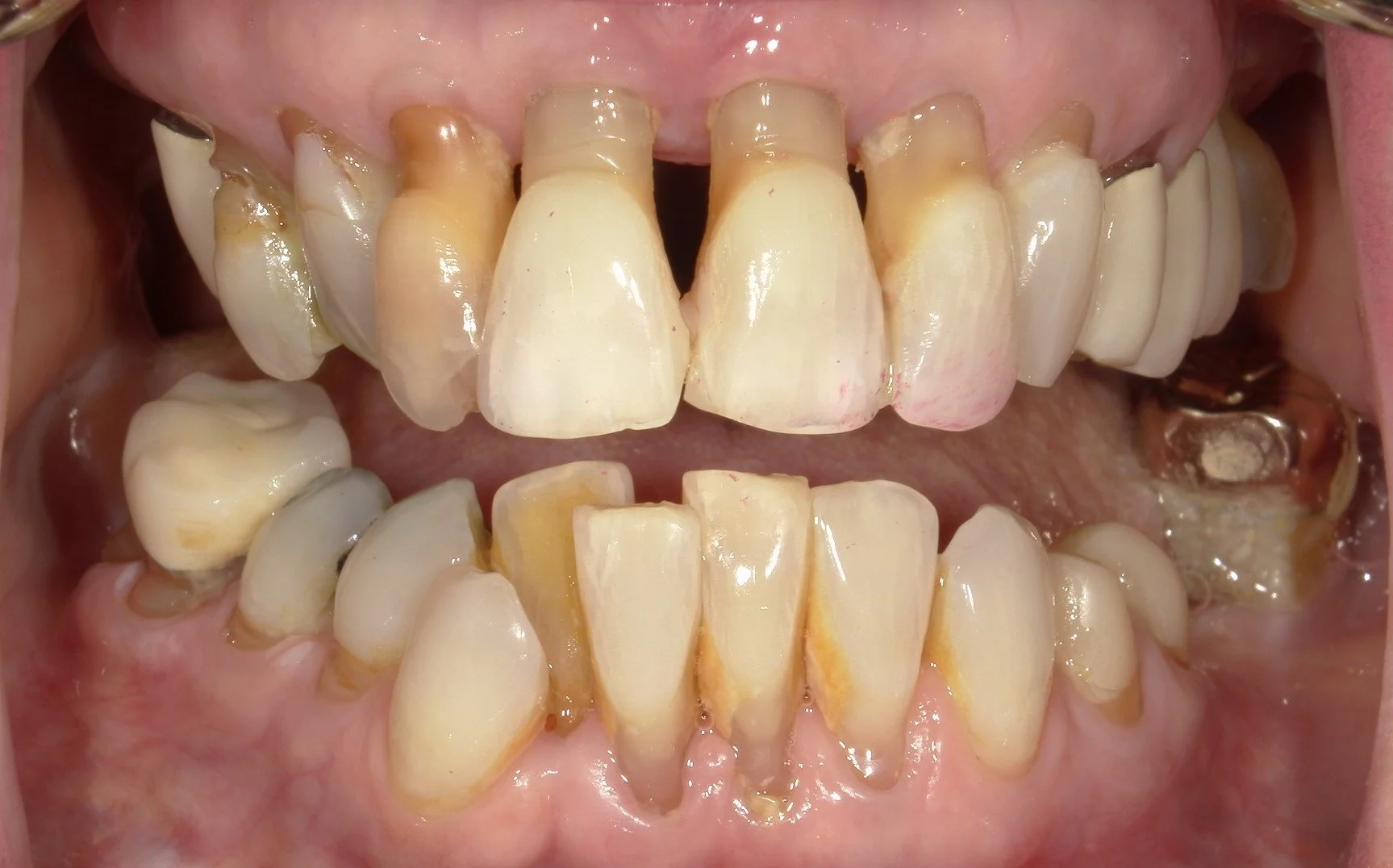 Full Mouth Open Before Treatment
