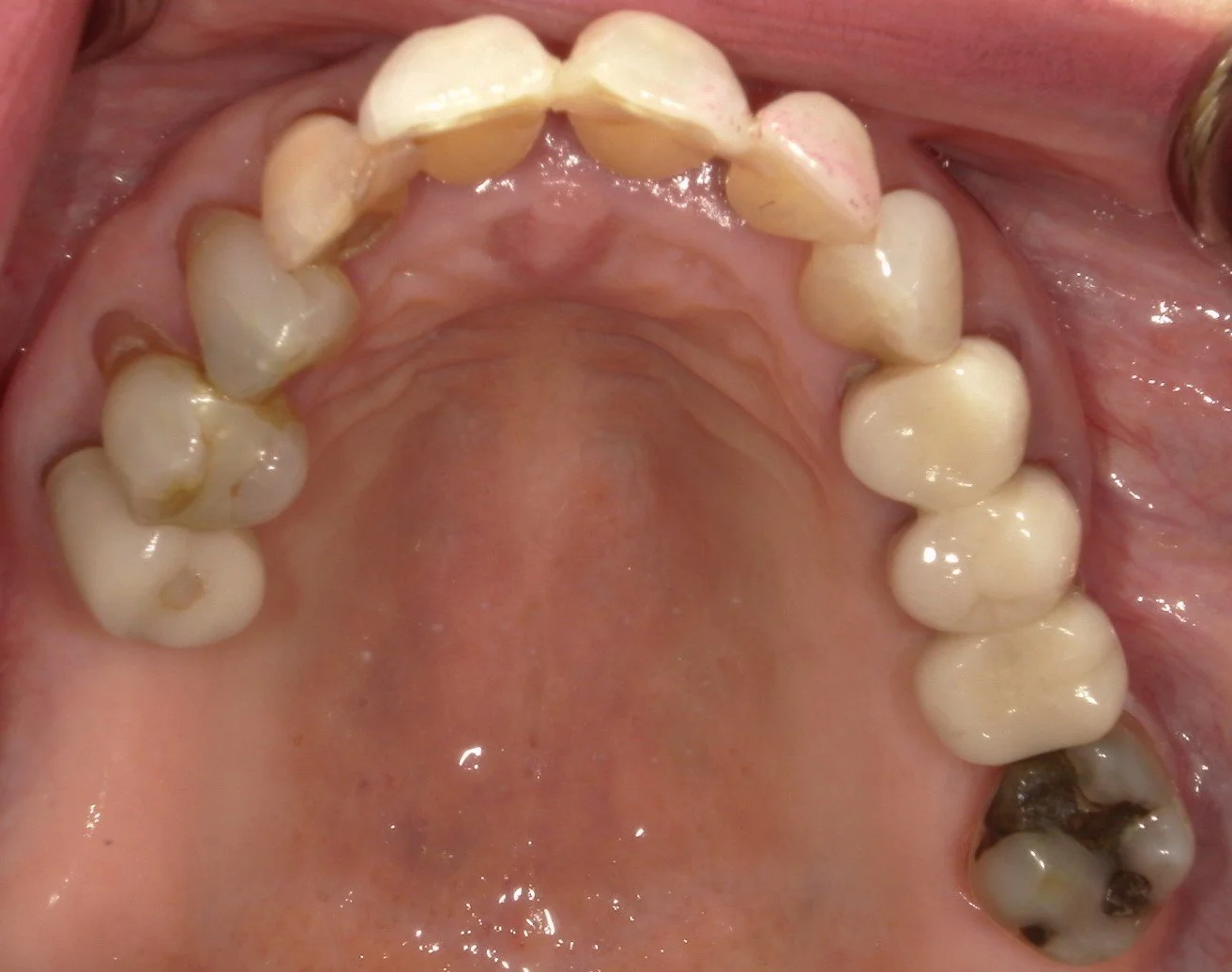 Upper Occlusal Before Treatment