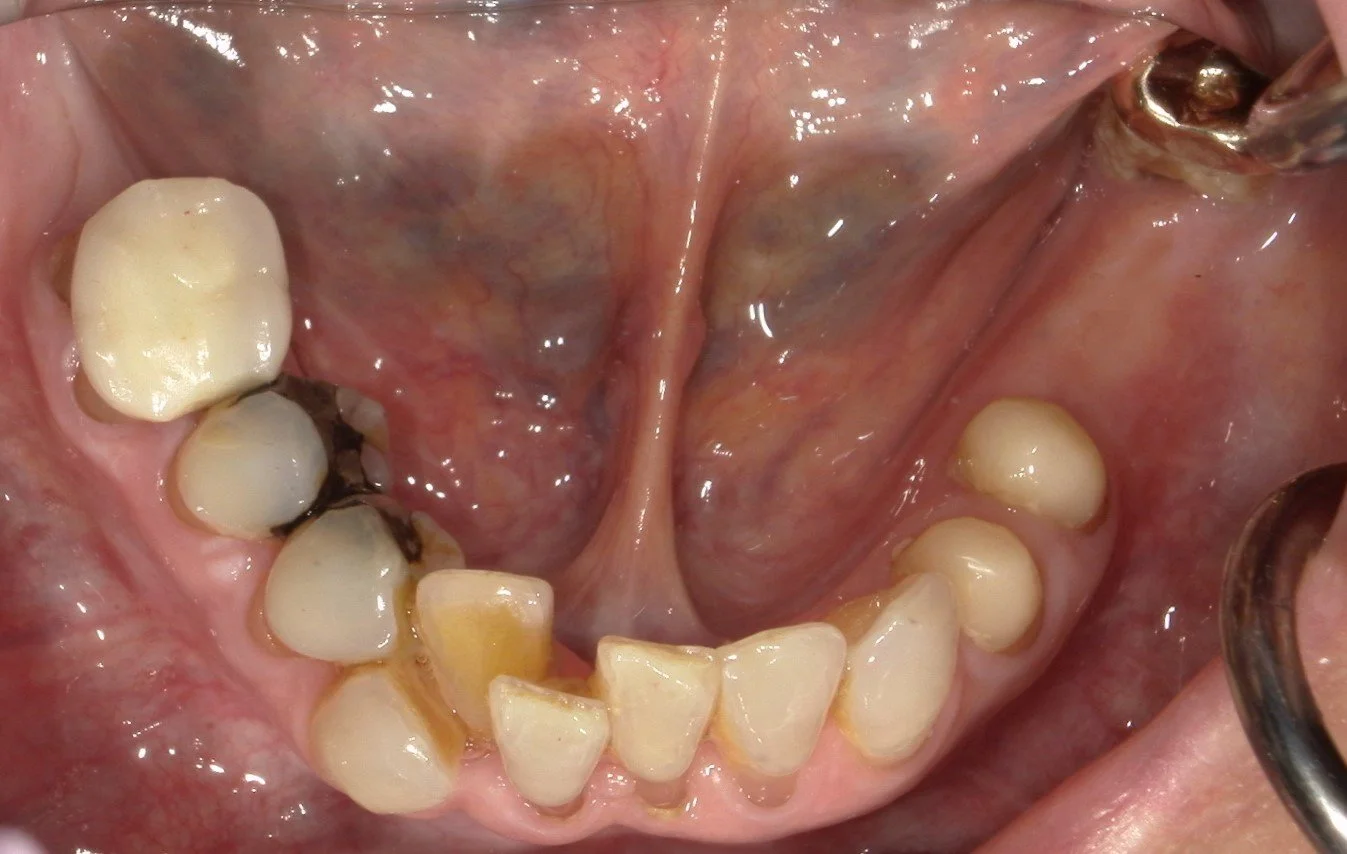 Lower Occlusal Before Treatment 