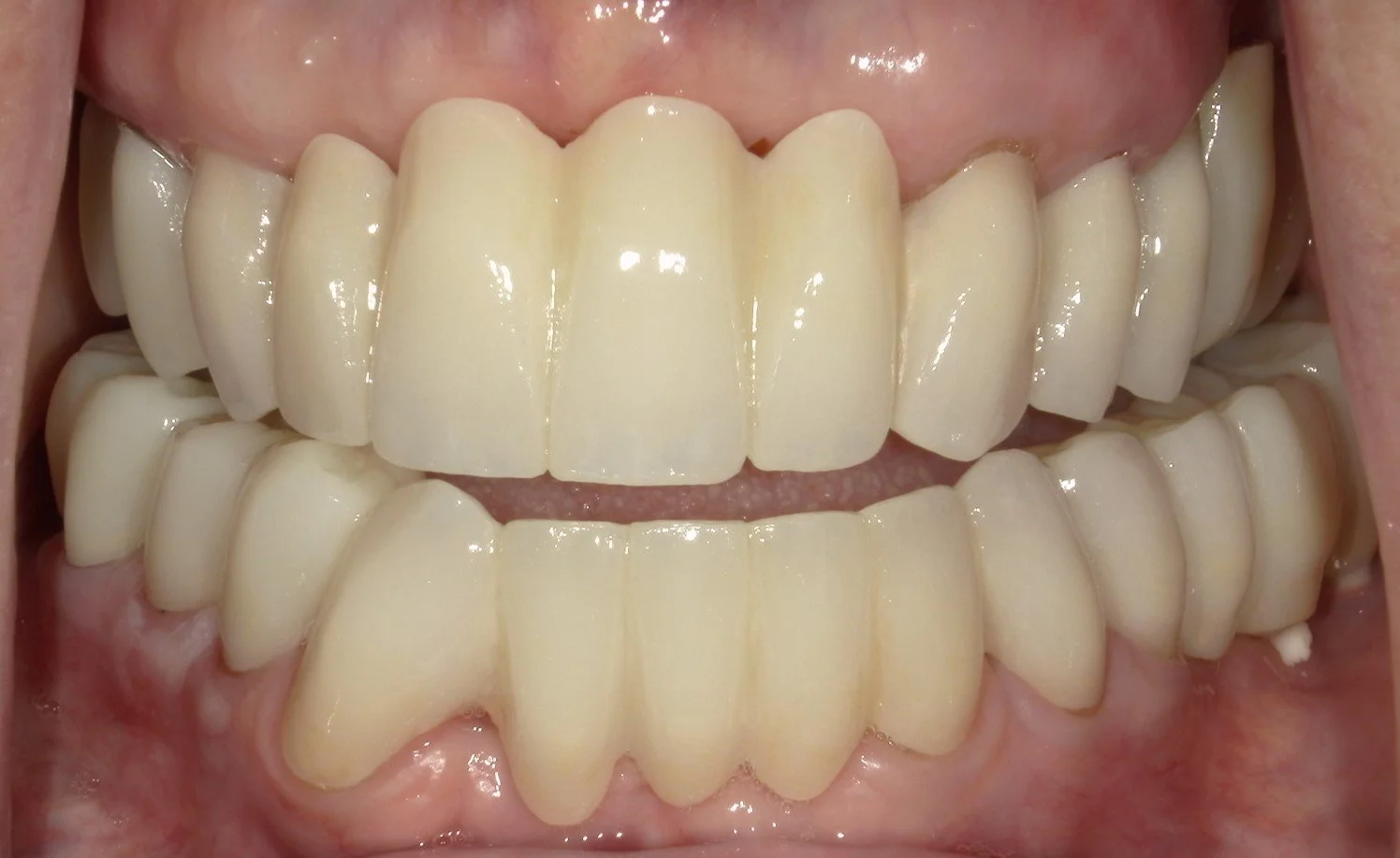 Full Mouth Open After Treatment