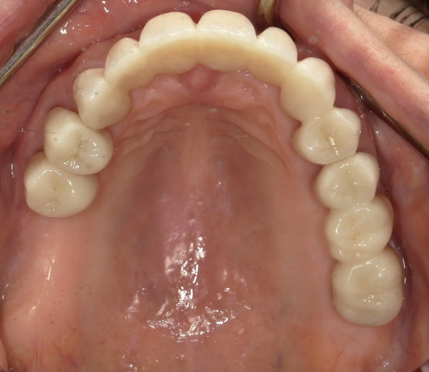 Upper Occlusal After Treatment