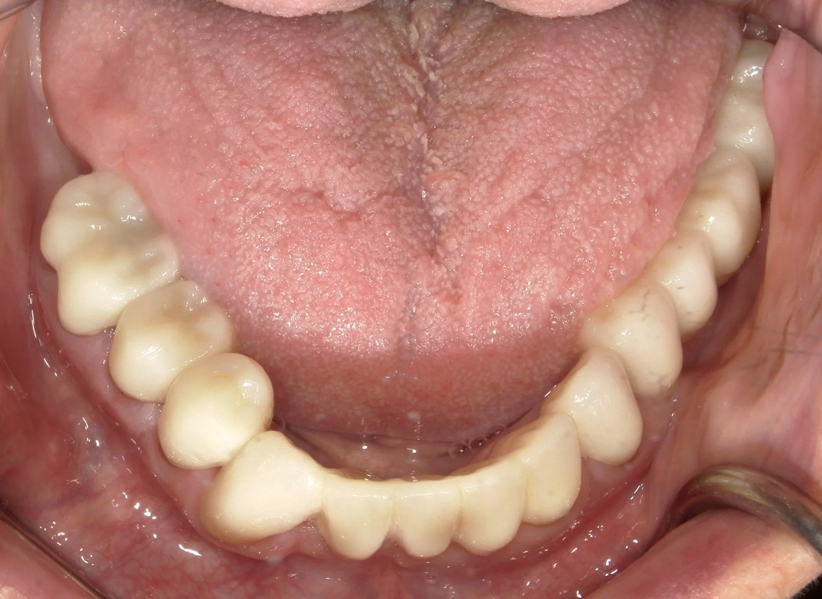 Lower Occlusal After Treatment