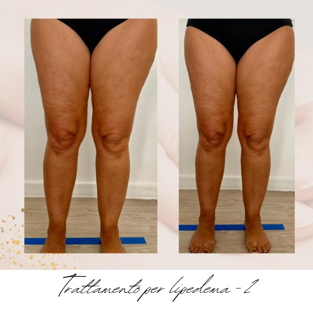 gambe donna lipedema prima e dopo.png
