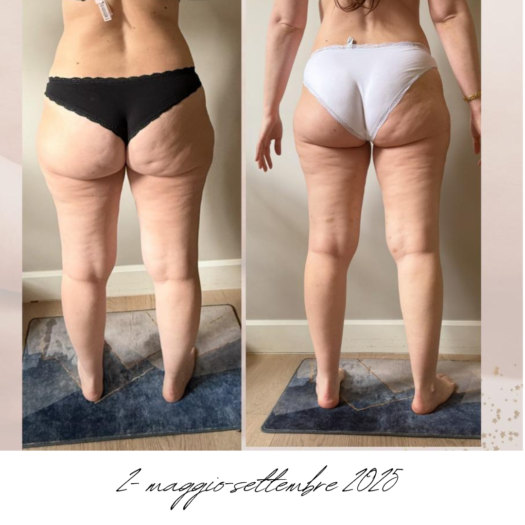 gambe donna lipedema prima e dopo.png