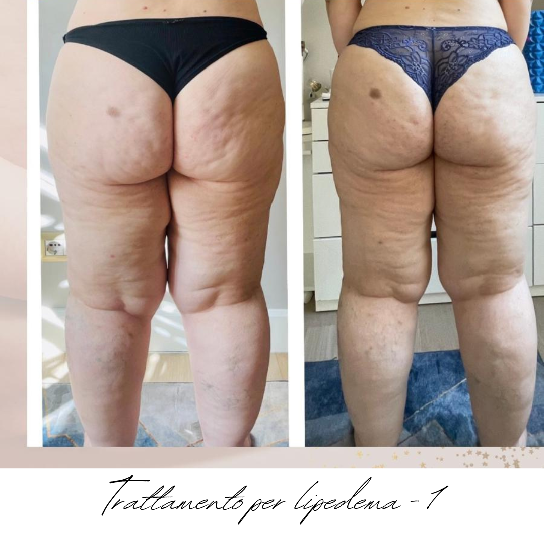 gambe donna lipedema prima e dopo.png
