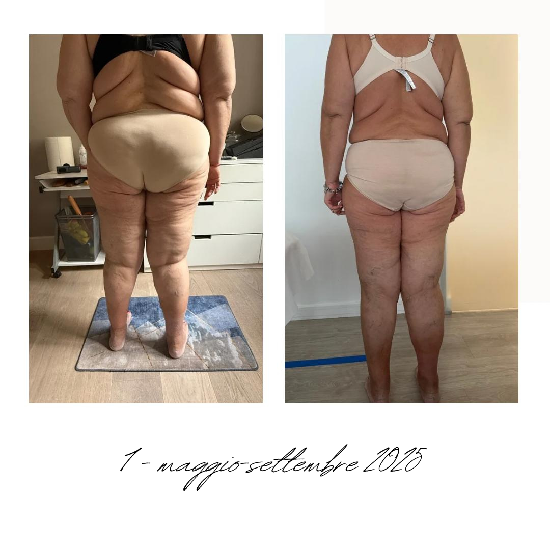 gambe donna lipedema prima e dopo.png