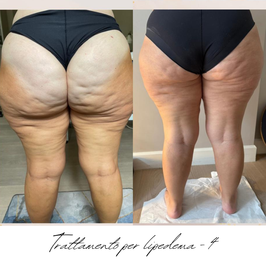 gambe donna lipedema prima e dopo.png