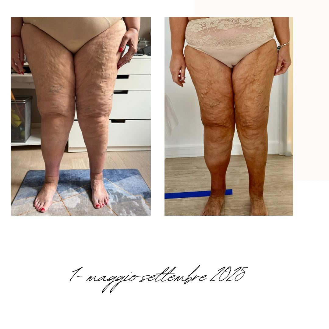 gambe donna lipedema prima e dopo.png
