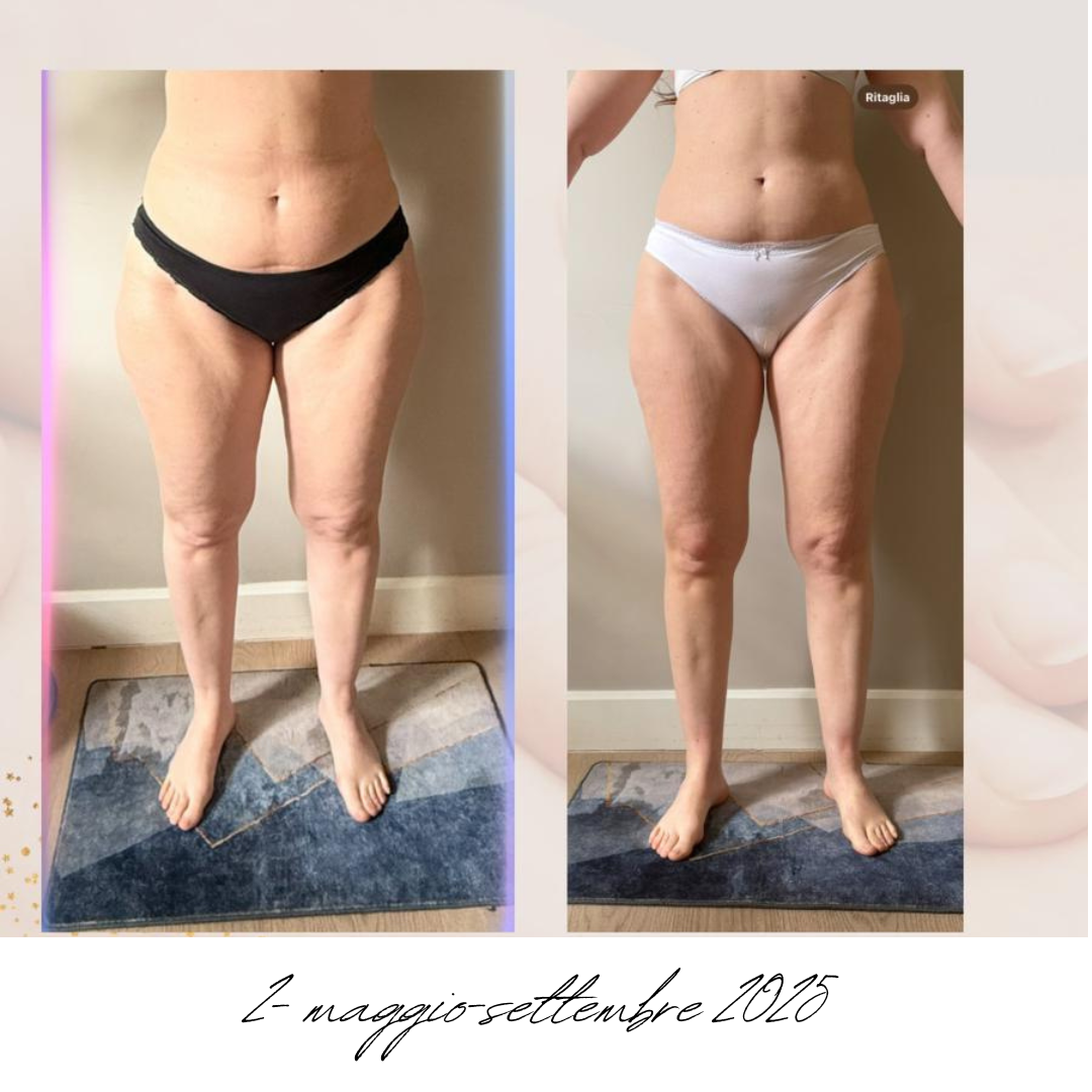 gambe donna lipedema prima e dopo.png