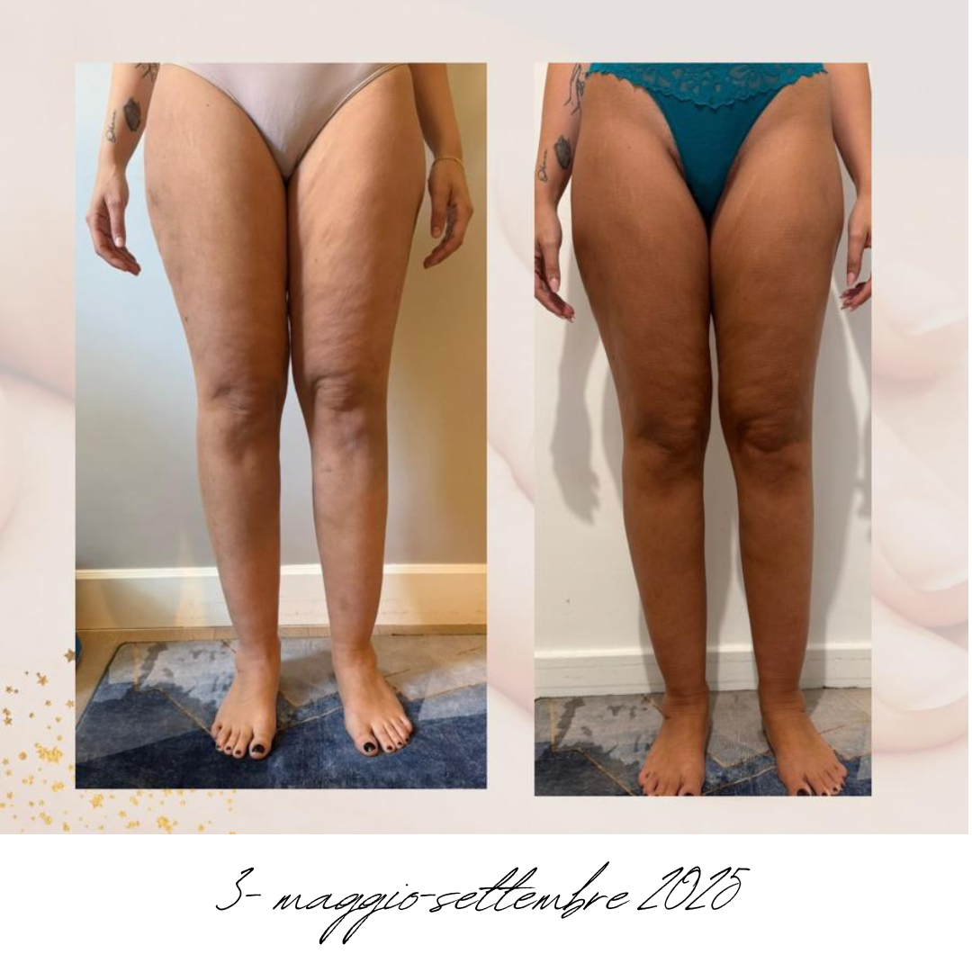 gambe donna lipedema prima e dopo.png
