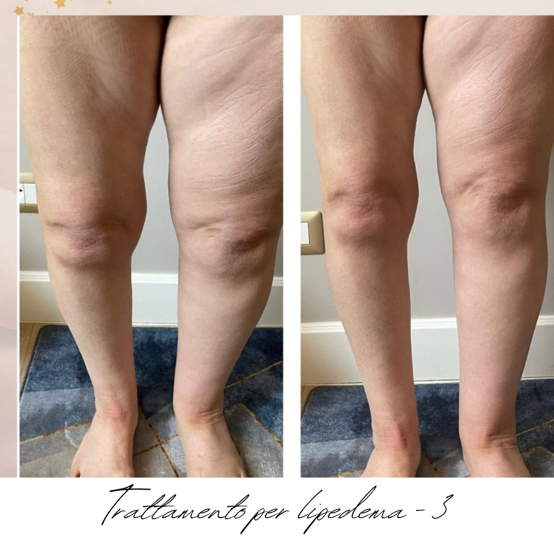 gambe donna lipedema prima e dopo.png