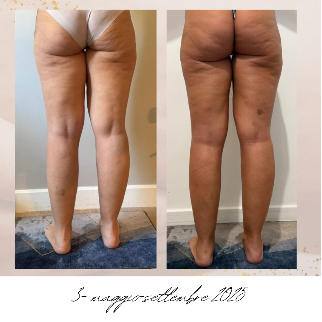 gambe donna lipedema prima e dopo.png