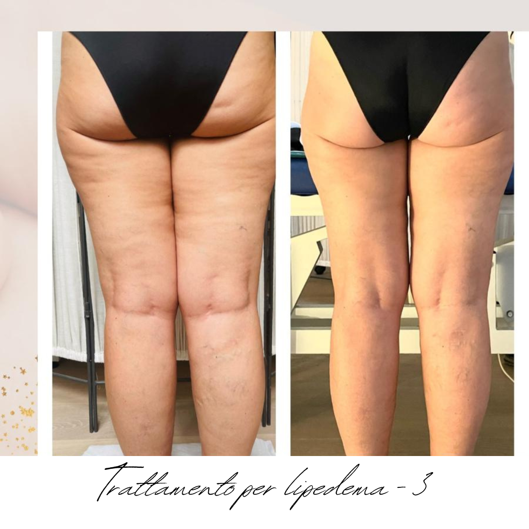 gambe donna lipedema prima e dopo.png