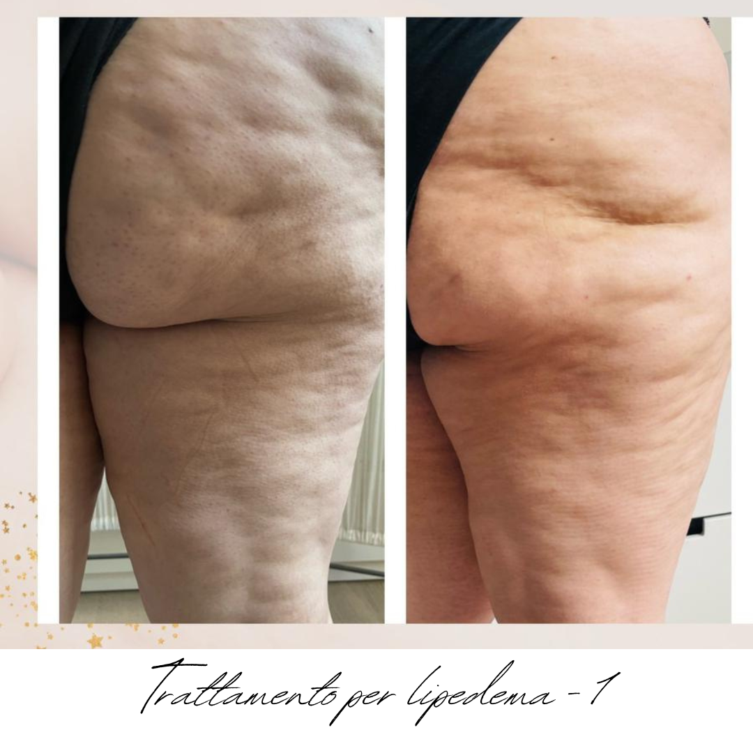 gambe donna lipedema prima e dopo.png