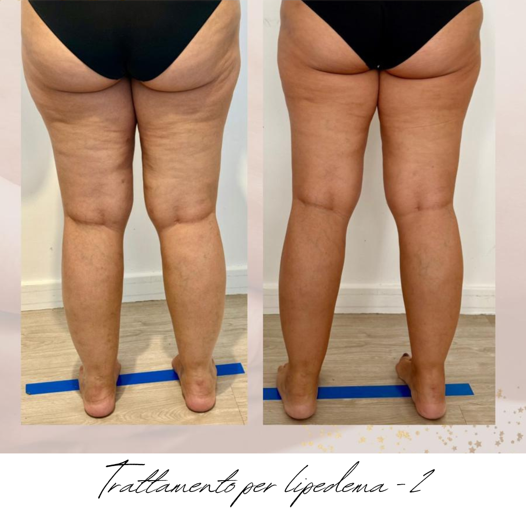 gambe donna lipedema prima e dopo.png