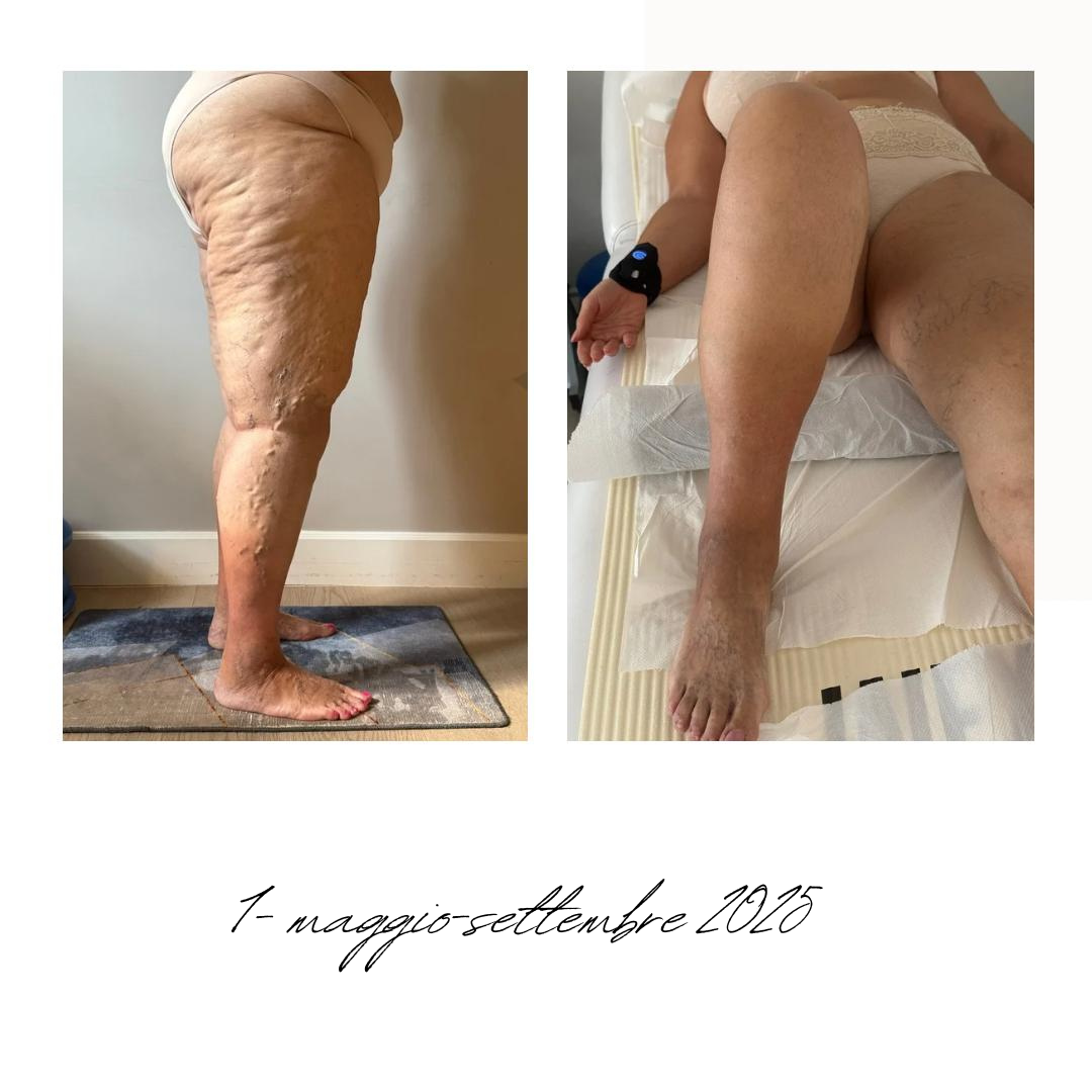 gambe donna lipedema prima e dopo.png