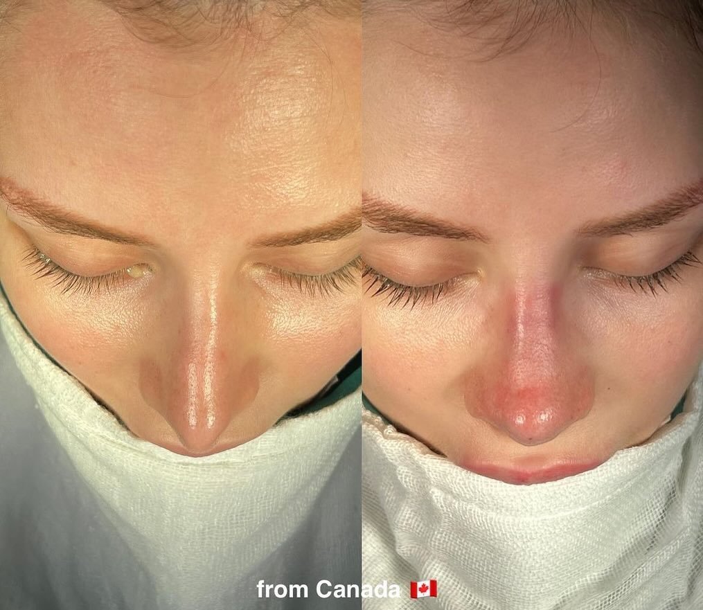 Hello everyone 💛

We would like to share with you a heartwarming story about one of our patients from Canada who recently underwent Revision Rhinoplasty. After her first surgery, she was not satisfied with the results and came to us for revision. We