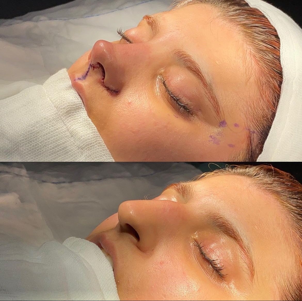 Hello everyone 💛

We wanted to share with you a story about one of our patients from Canada who recently underwent Rhinoplasty. At first, she was nervous about the procedure, but we did everything in our power to make sure she was comfortable and we