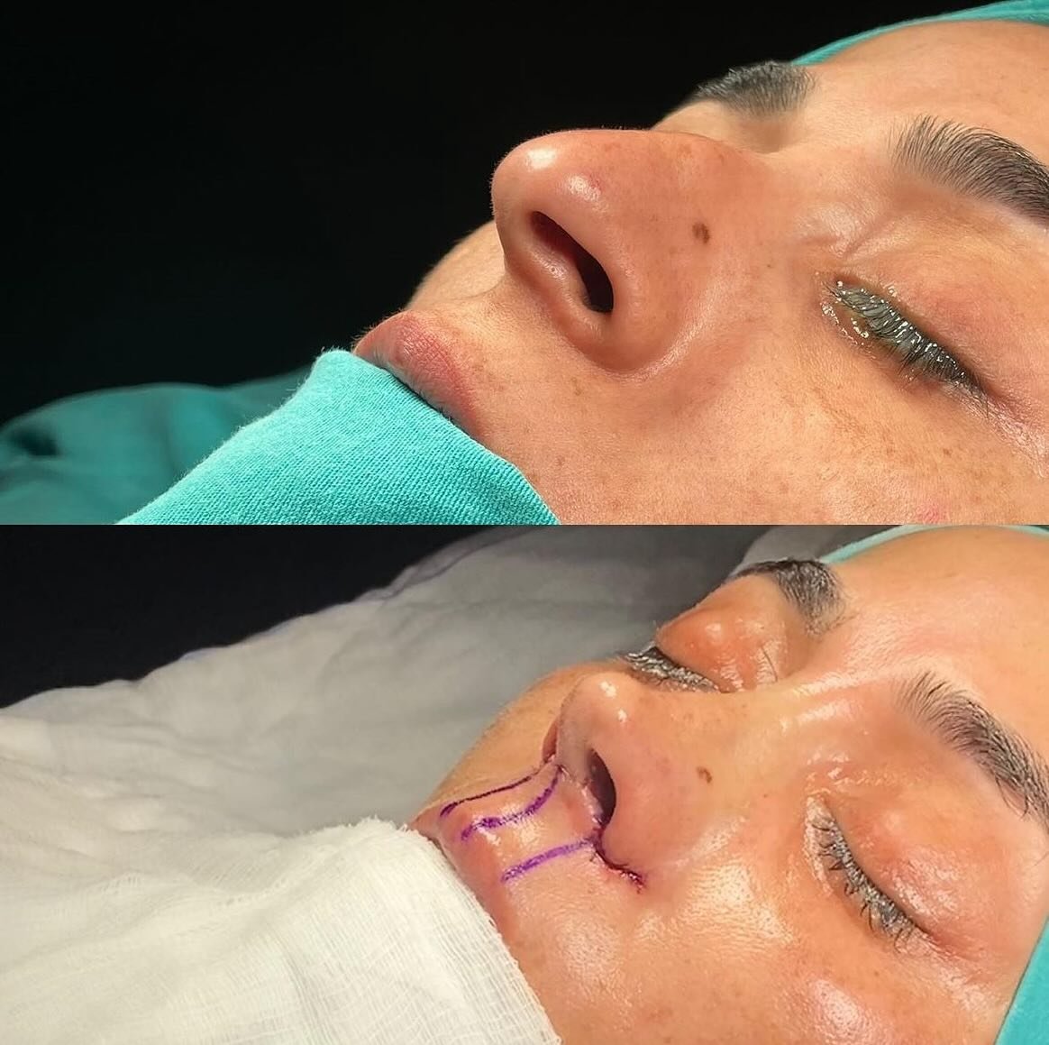 Hello everyone 💛

We would like to share the story of one of our patients from France who underwent rhinoplasty to achieve her desired look. She was very excited about the procedure and it was important for her to feel her best self. We are thrilled