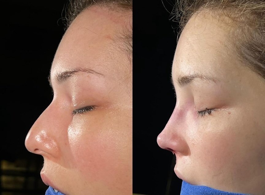 Hello everyone 💛
We have a heartwarming story to share about a patient from the UK who recently had Rhinoplasty. We are overjoyed to report that she is now incredibly happy with the outcome of the surgery, and we feel privileged to have played a rol
