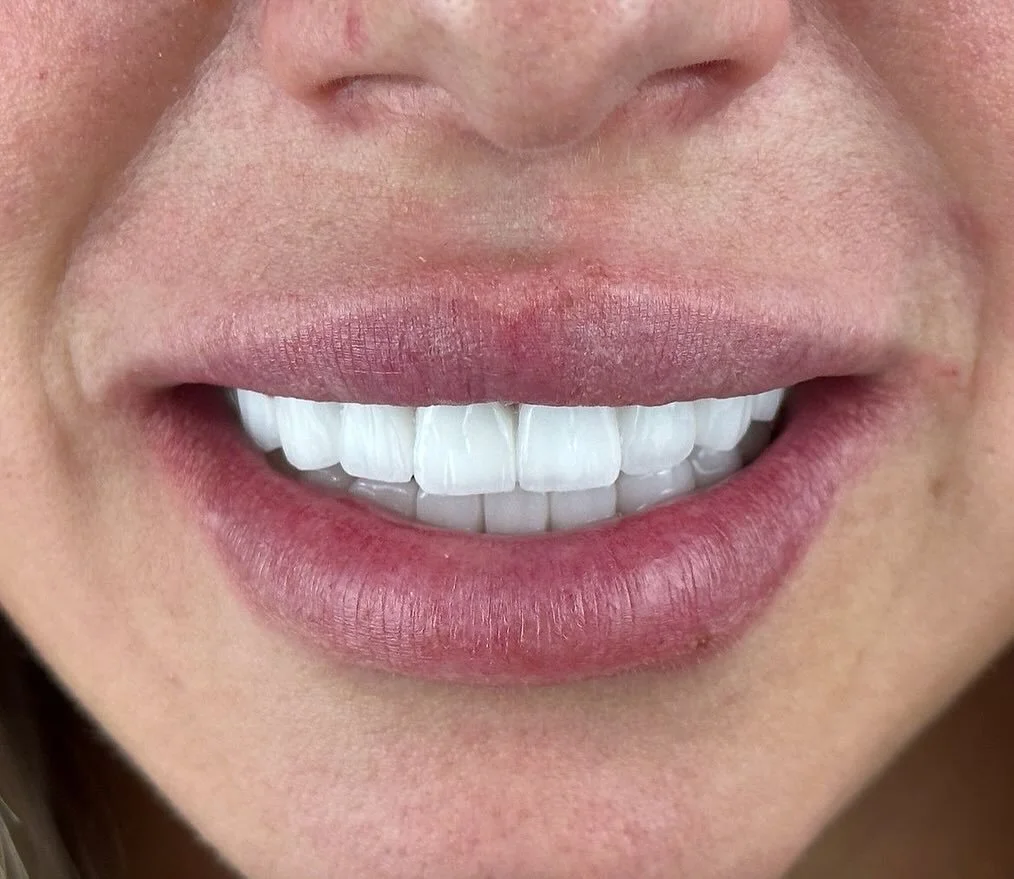 Is It Safe to Get Dental Veneers in Turkey?An Honest Guide for US, UK &amp; Australian Patients (2026)