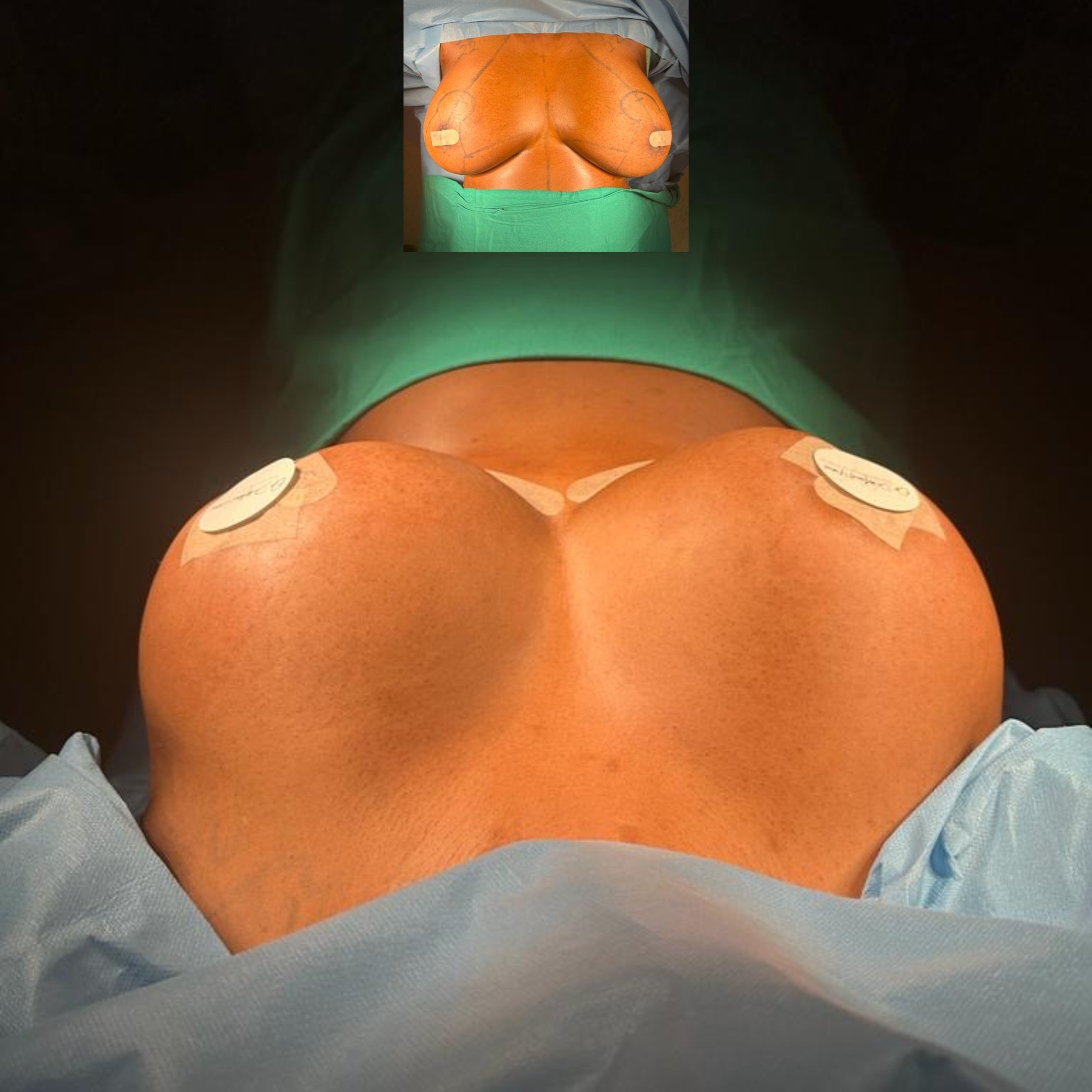 Breast lift before and after – natural uplift results after surgery at Seta Clinic Istanbul
