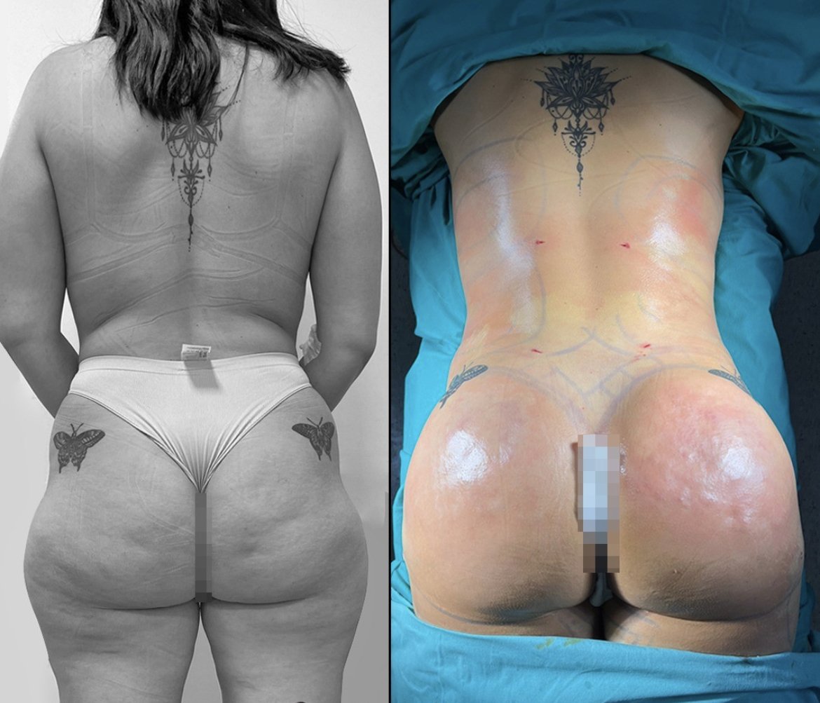 Before and after images showing a person's back and buttocks, highlighting changes post-cosmetic procedure. Tattoos visible on the lower back and upper thighs. The left image is in black and white, while the right image shows a marked improvement in