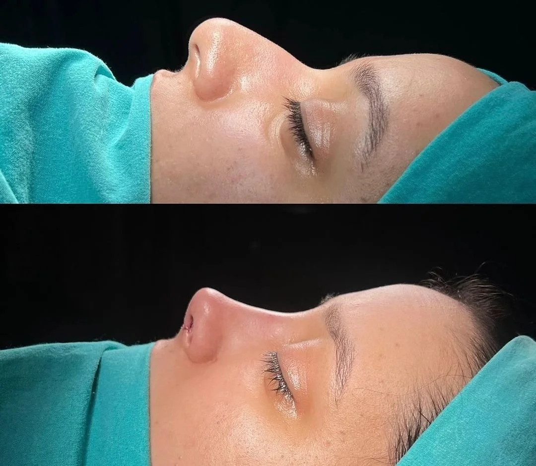 Side-by-side comparison of a person's profile before and after a rhinoplasty surgery, with a focus on nose shape changes.