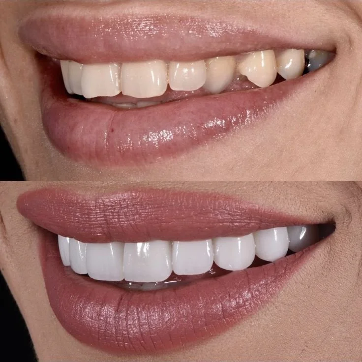 Comparison photo showing teeth before and after dental whitening, with the top showing yellowed teeth and the bottom showing bright, white teeth.